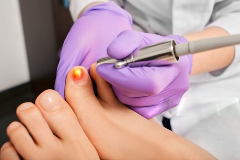 Laser Treatment for Nail Fungus: Why 980nm Diode Laser Is Becoming the Preferred Professional Solution​