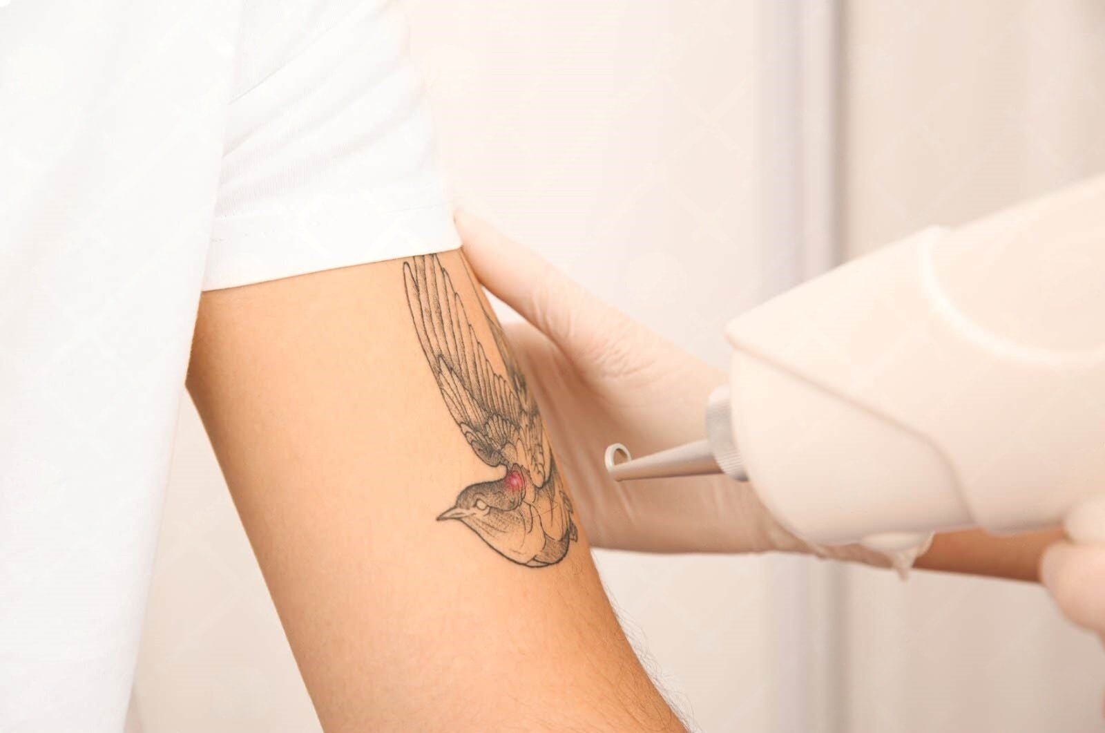 The Ultimate Guide to Professional Laser Tattoo Removal Machines